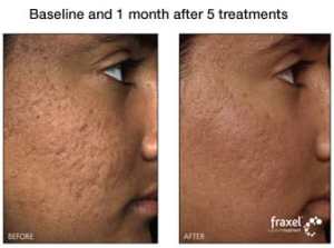 fraxel before and after