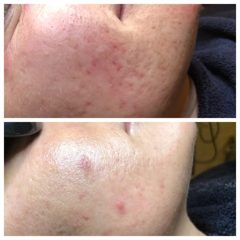 Acne Scars before and after