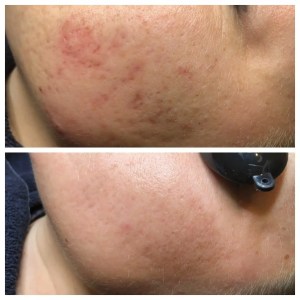 Acne Scars before and after