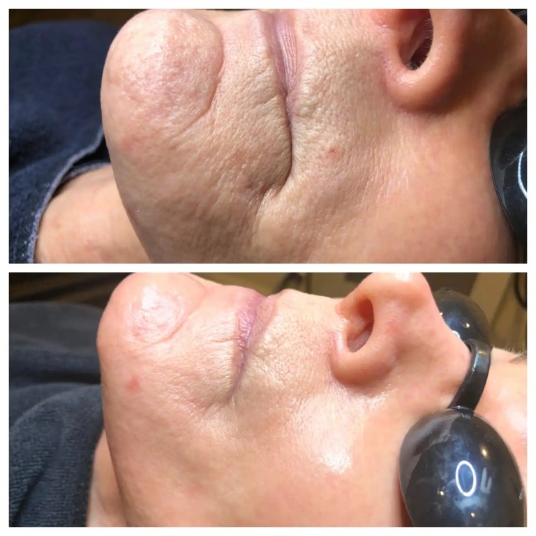 Skin Pen before and after