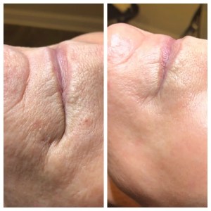 SkinPen before and after