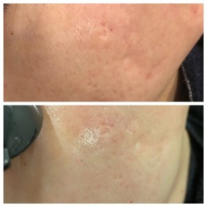 Skin-Pen before and after