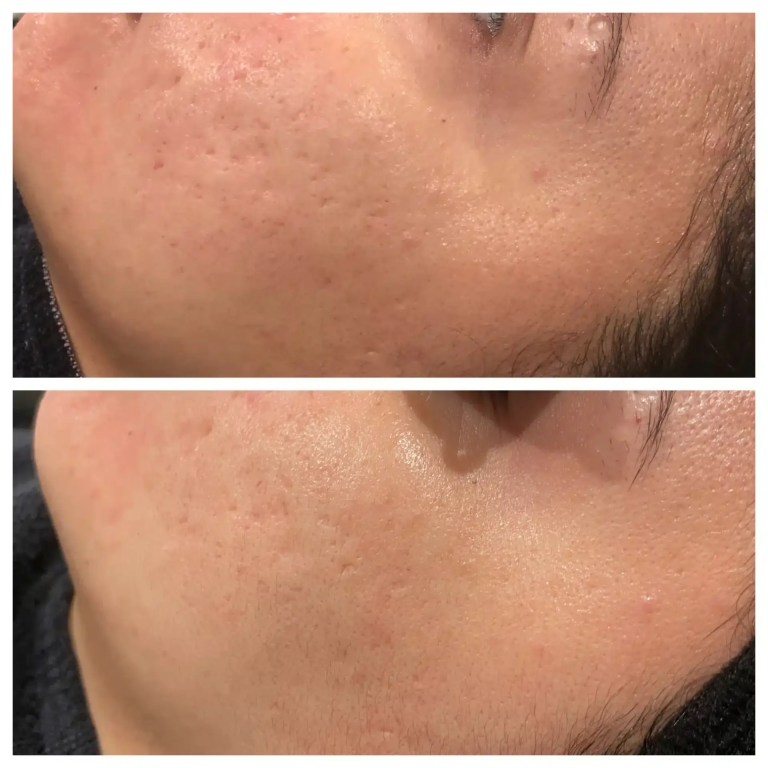 skin pen before and after