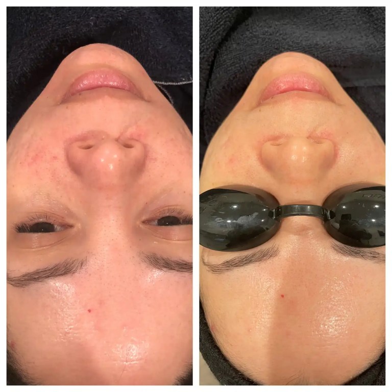skinpen before and after