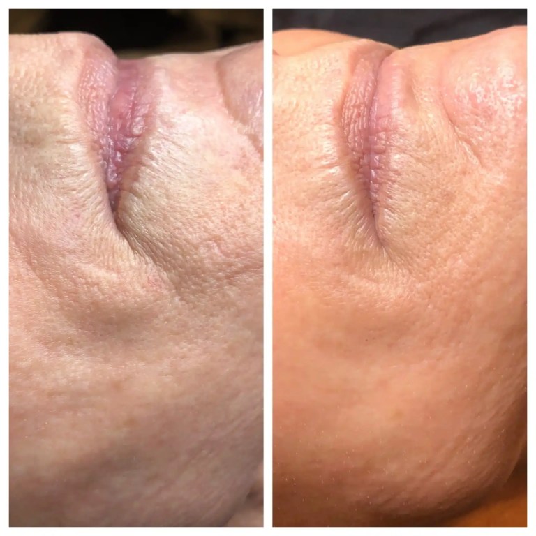 skin pen before and after