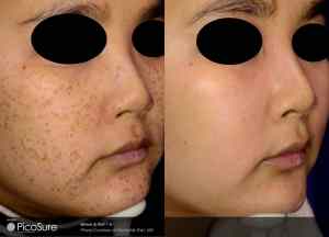 freckles before and after
