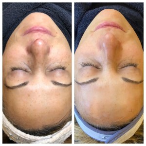 before and after ipl