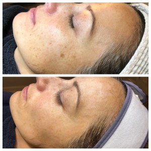 ipl before and after