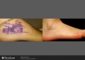 tattoo removal before and after