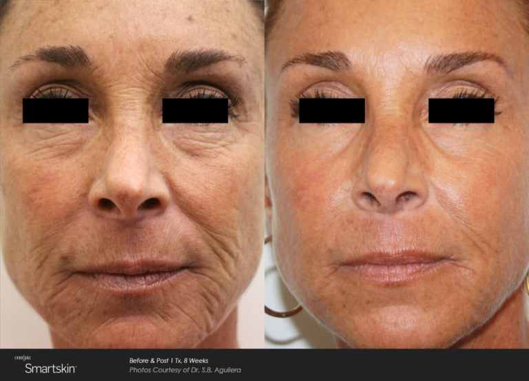 smartskin before and after