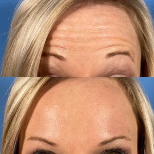 before-and-after comparison of forehead lines