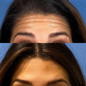 before-and-after comparison forehead lines