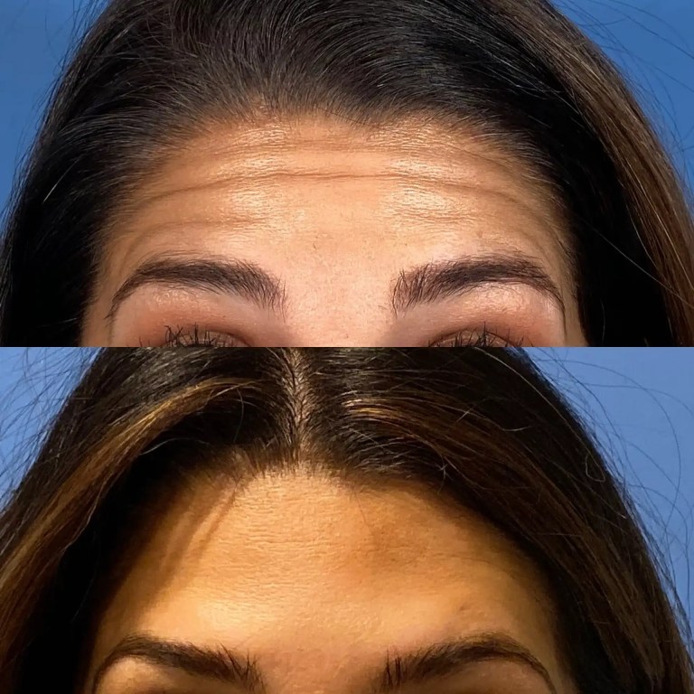 before-and-after comparison forehead lines