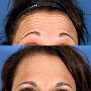 comparison of forehead lines before-and-after