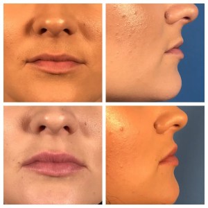 before-and-after results of a lip lift surgery