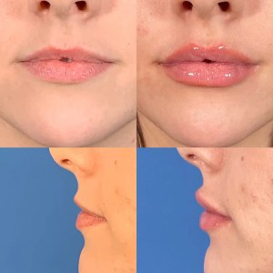 results of a lip lift surgery before-and-after