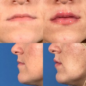before-and-after results of lip lift surgery
