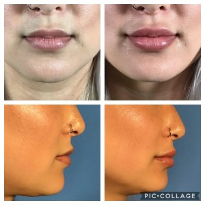 before-and-after results of a lip lift surgery.