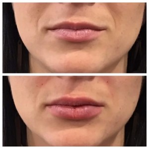 dermal fillers or a lip flip
