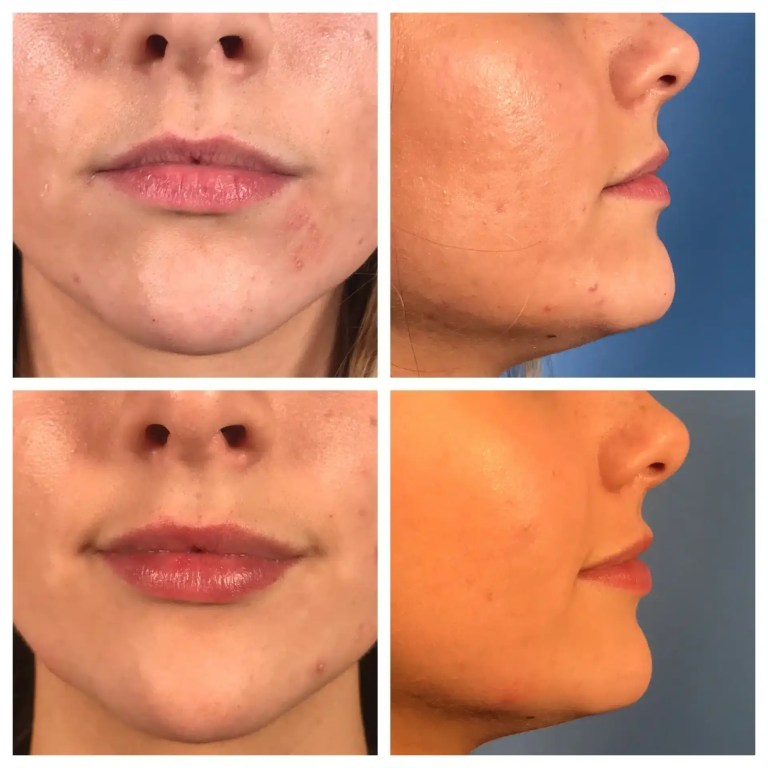 dermal fillers or a lip flip