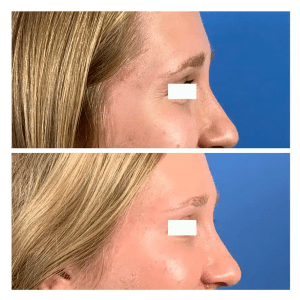 Botox1 before and after
