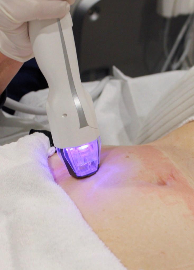 Fractional CO2 laser handpiece delivering controlled pulses during a skin resurfacing treatment