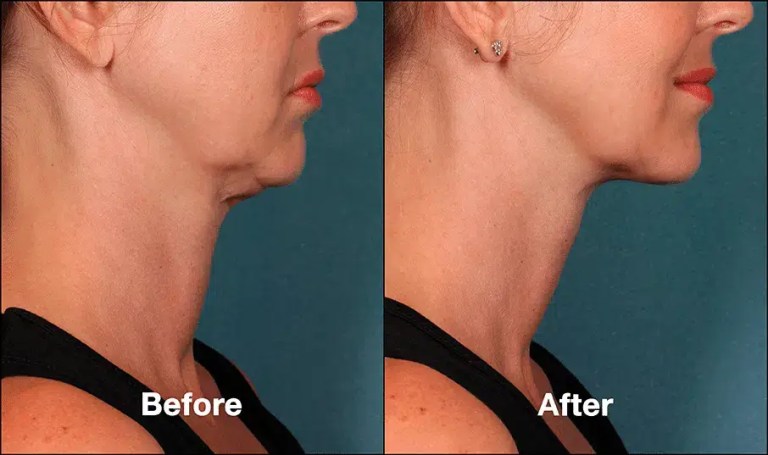 kybella before after