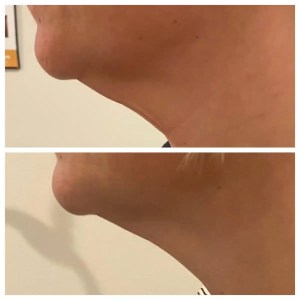 kybella chin before after